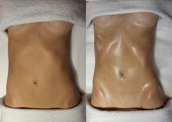 Masaje Reductor Precio Masaje Magic Redux Tratamiento Reductor